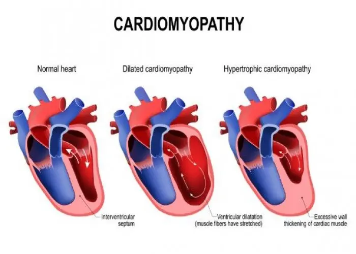 Dilated cardiomyopathy