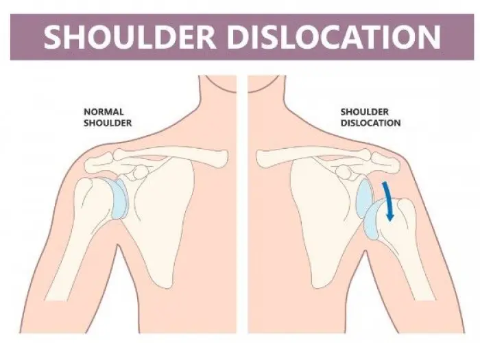 Dislocated shoulder