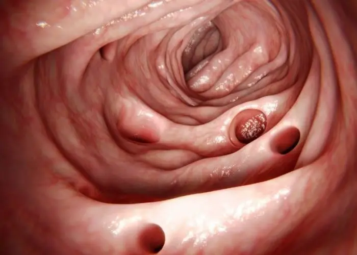 Diverticulitis