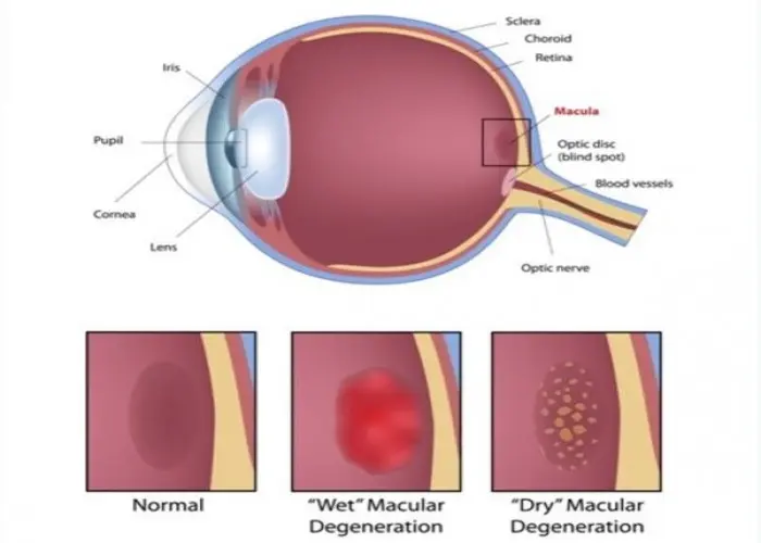 Dry macular degeneration