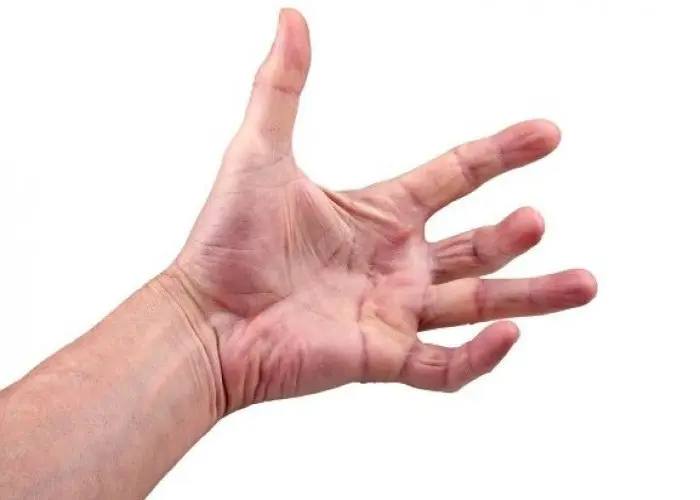 Dupuytren's contracture