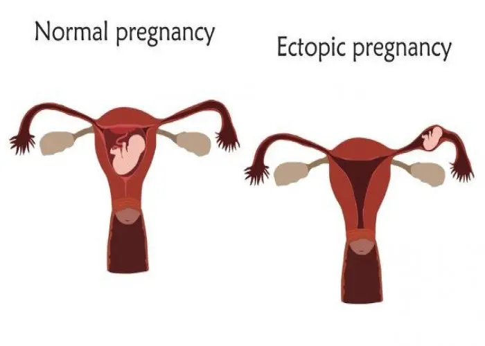 Ectopic pregnancy