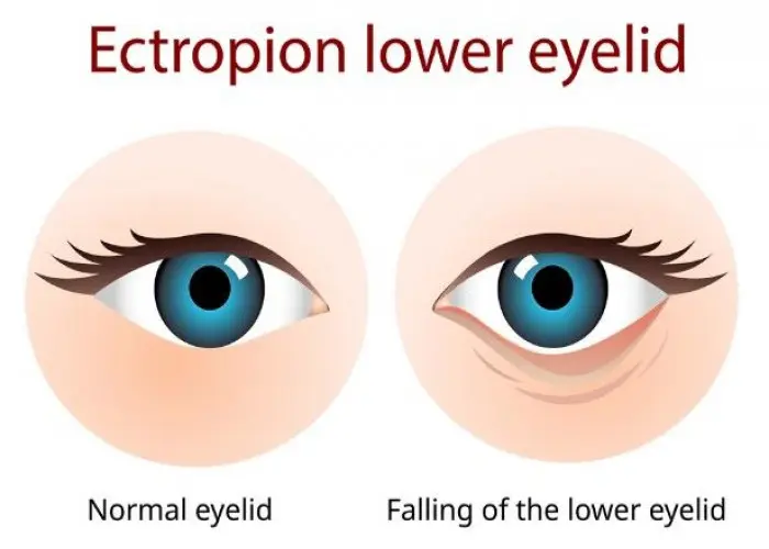 Ectropion