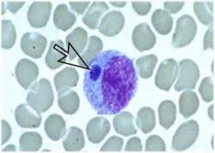 Ehrlichiosis and anaplasmosis