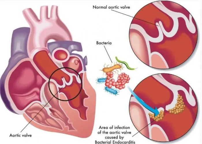 Endocarditis