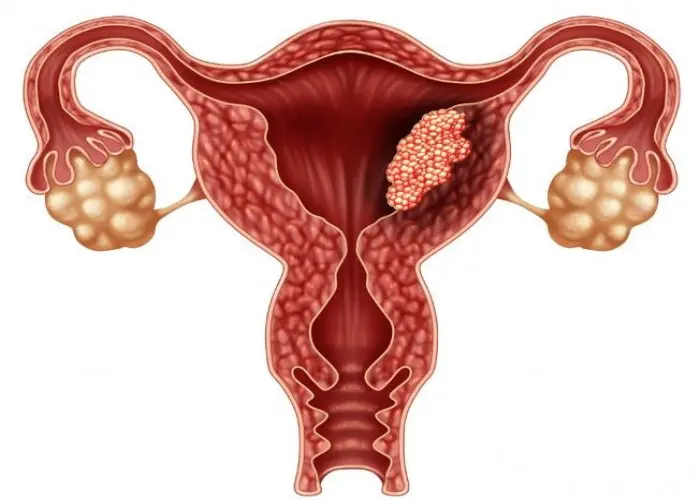 Endometrial cancer