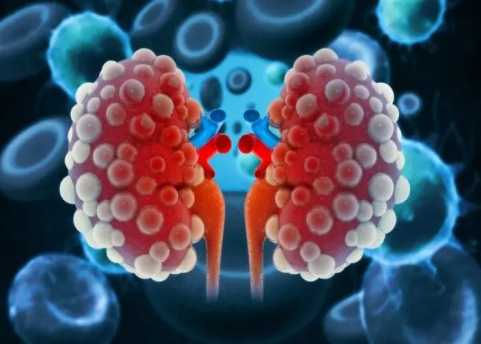 End-stage renal disease