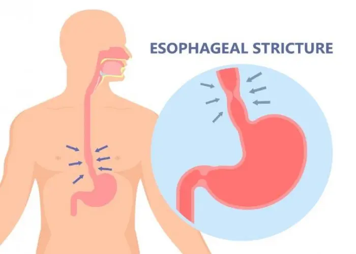 Eosinophilic esophagitis