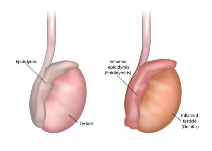 Epididymitis