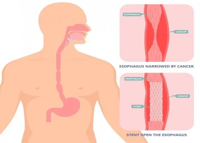 Epiglottitis