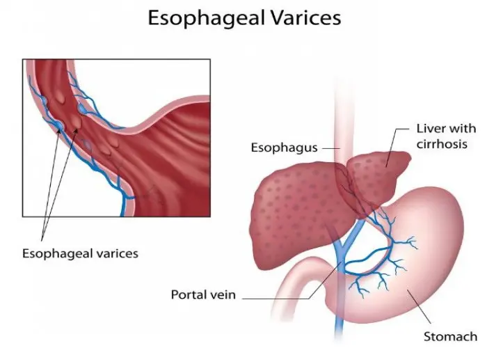 Esophageal varices