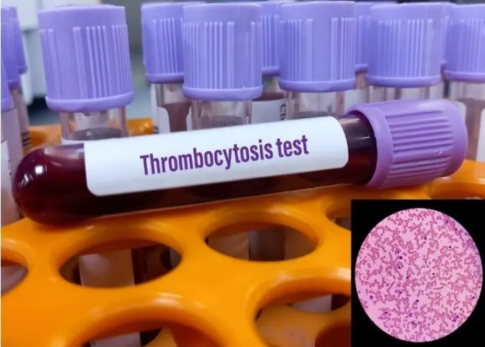 Essential thrombocythemia