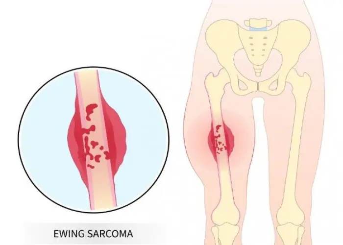 Ewing sarcoma