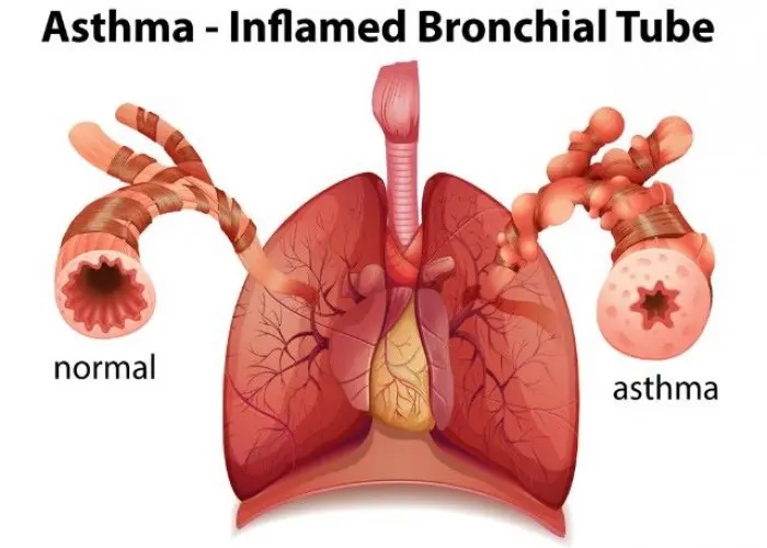 Exercise-induced asthma