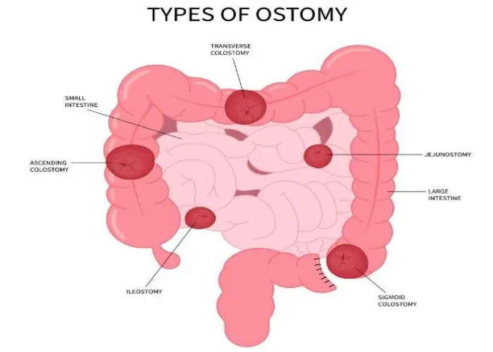 Familial adenomatous polyposis