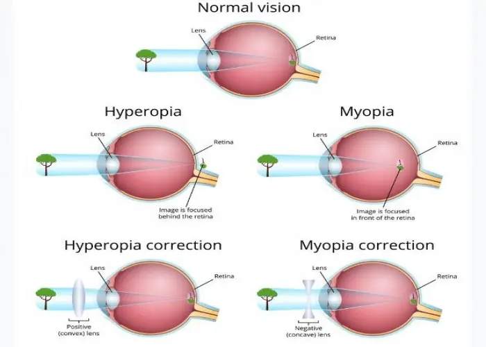 Farsightedness