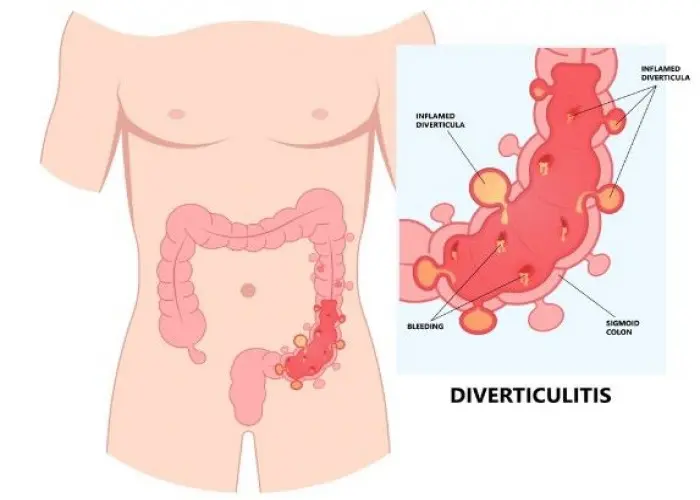 Fecal incontinence