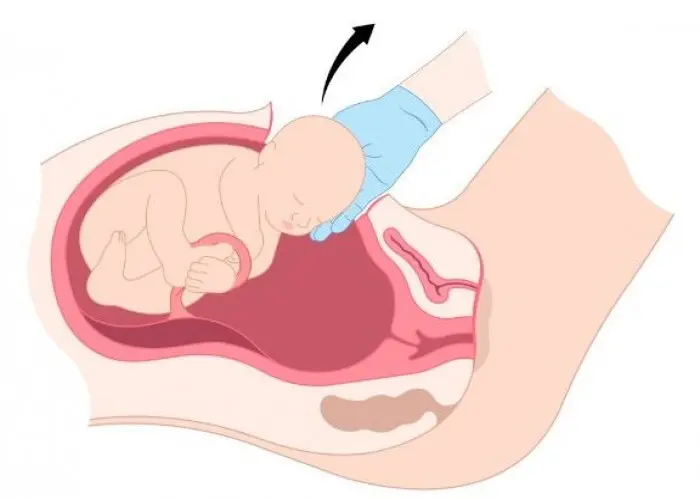 Fetal macrosomia