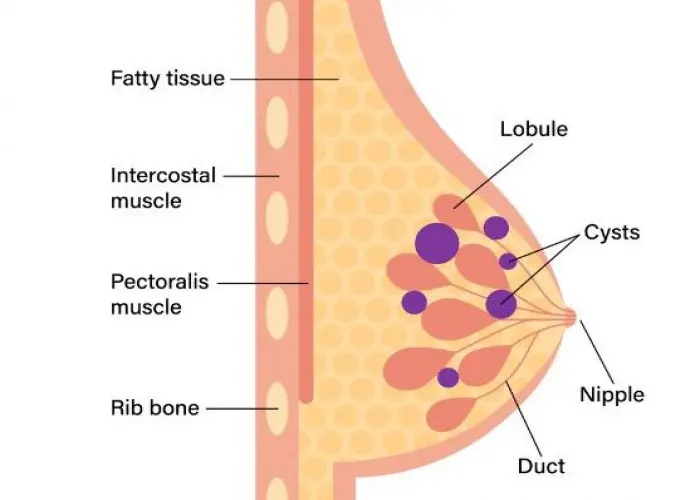 Fibrocystic breasts