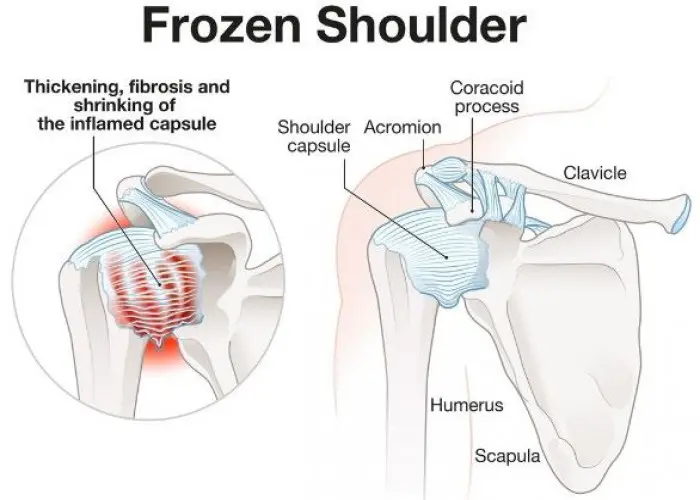 Frozen shoulder