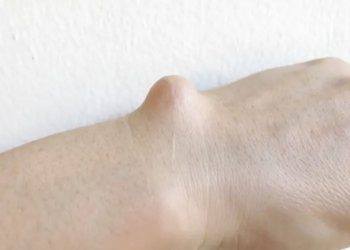 Ganglion cyst