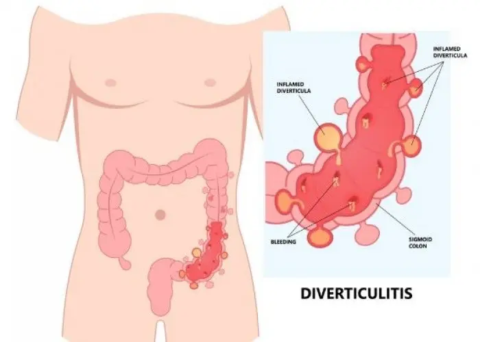 Gastrointestinal bleeding