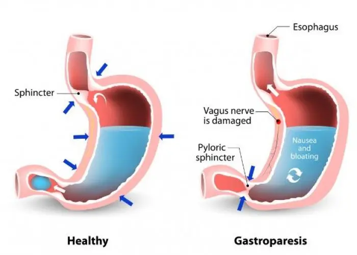 Gastroparesis