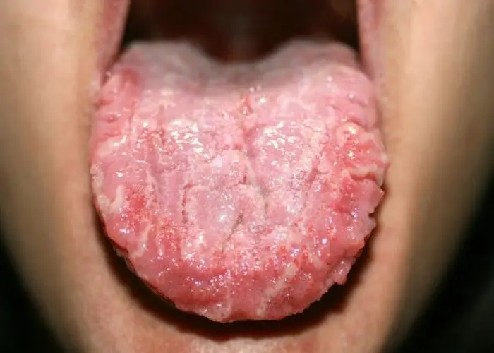 Geographic tongue