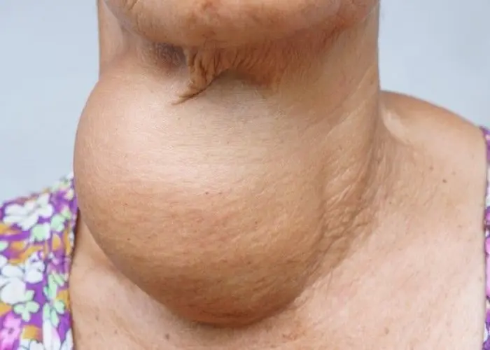 Goiter