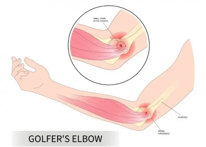 Golfer's elbow