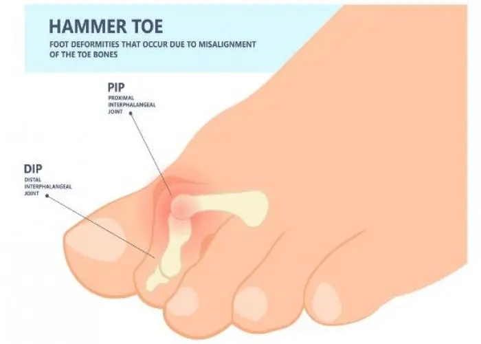 Hammertoe and mallet toe