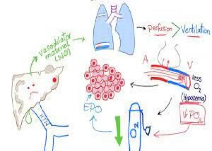 Hepatopulmonary syndrome