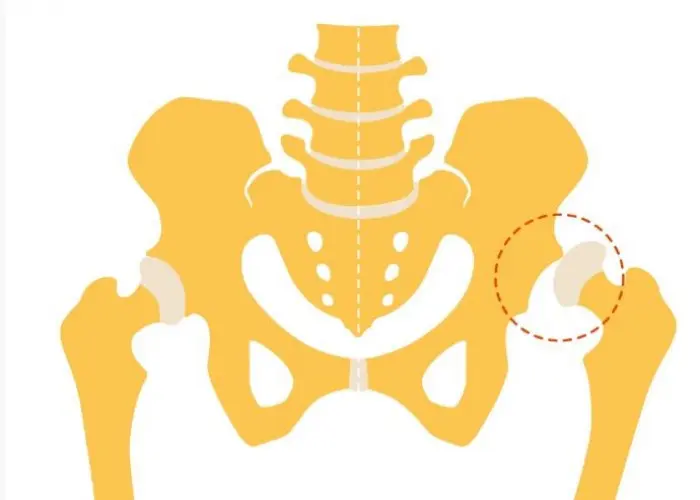 Hip dysplasia