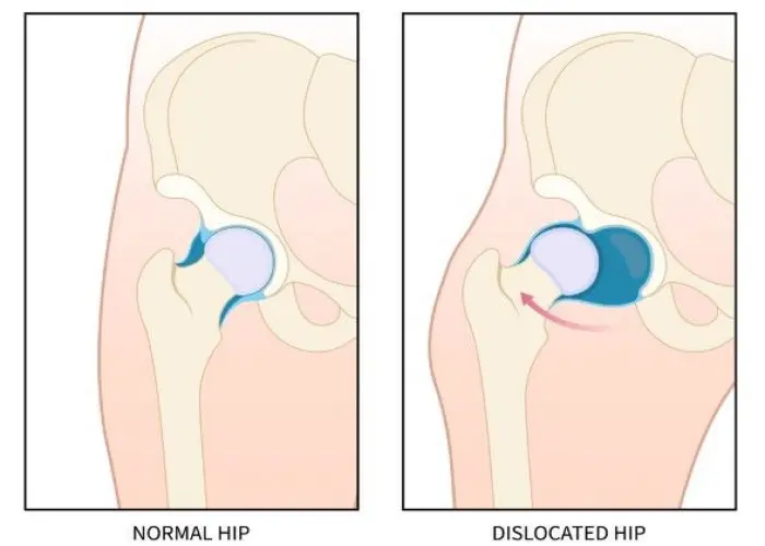 Hip impingement