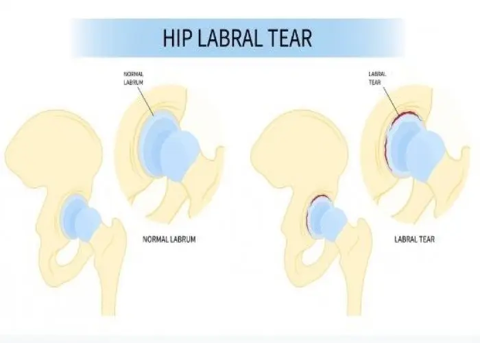 Hip labral tear