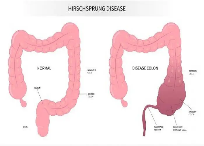 Hirschsprung's disease