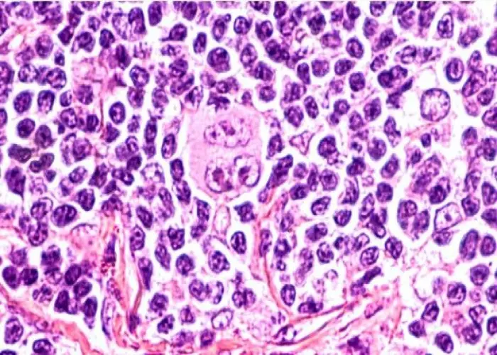 Hodgkin's lymphoma (Hodgkin's disease)