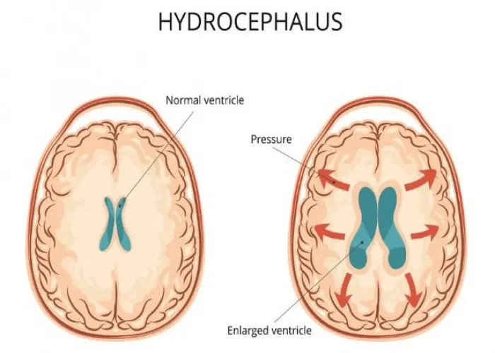 Hydrocephalus