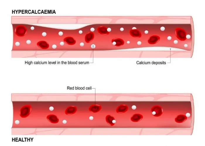 Hypercalcemia