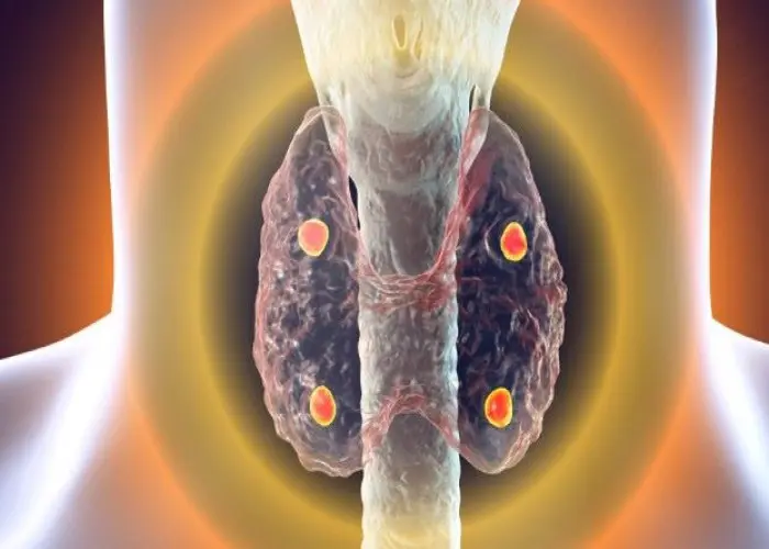 Hyperparathyroidism