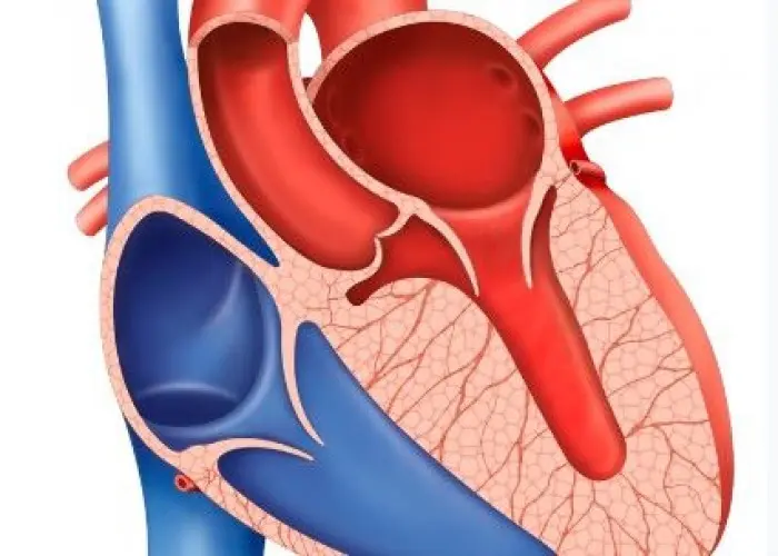 Hypertrophic cardiomyopathy