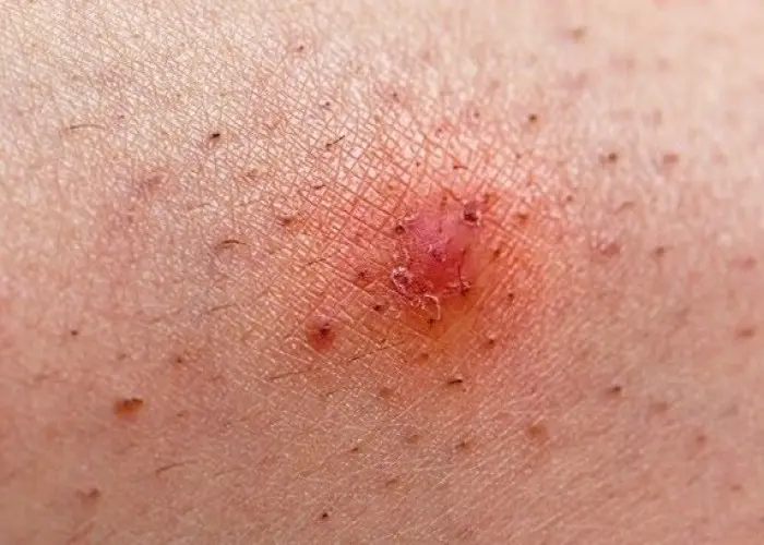 Ingrown hair