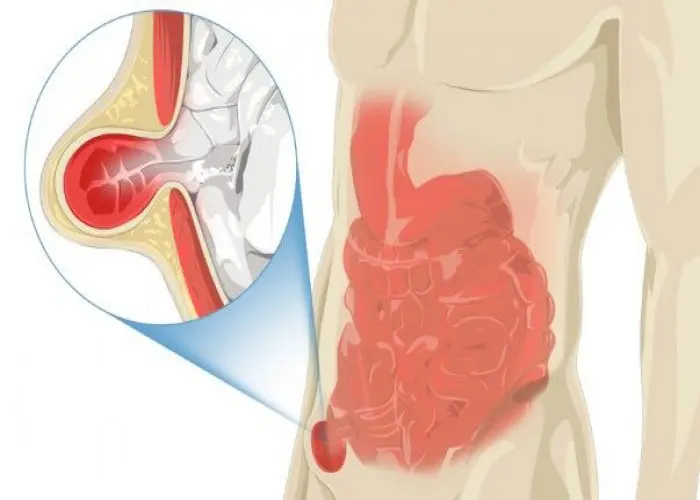 Inguinal hernia