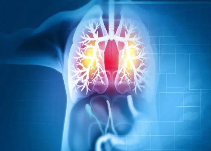 Interstitial lung disease