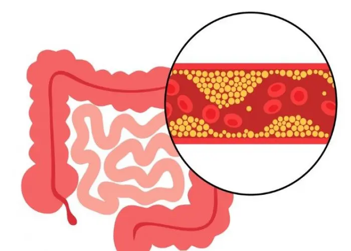 Intestinal ischemia