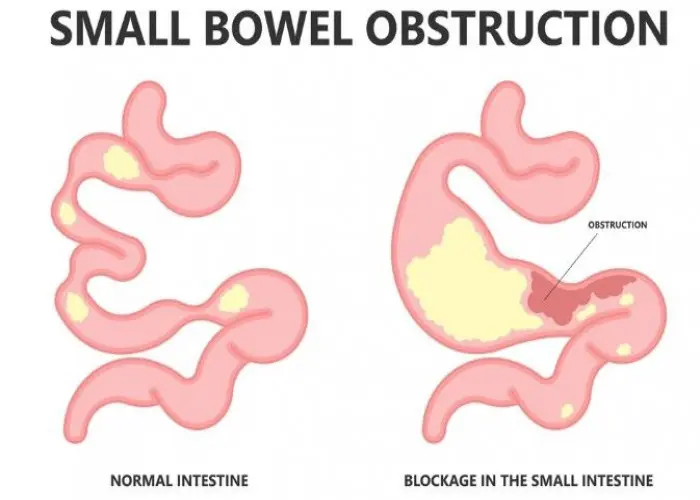 Intestinal obstruction