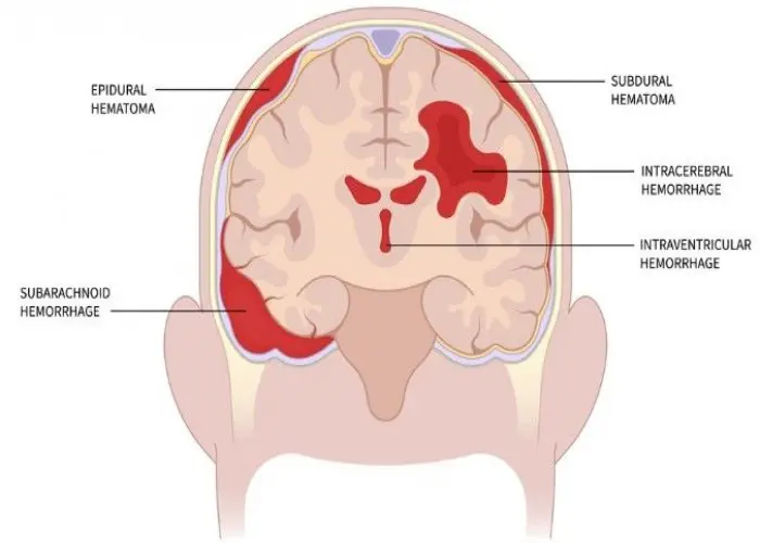 Intracranial hematoma