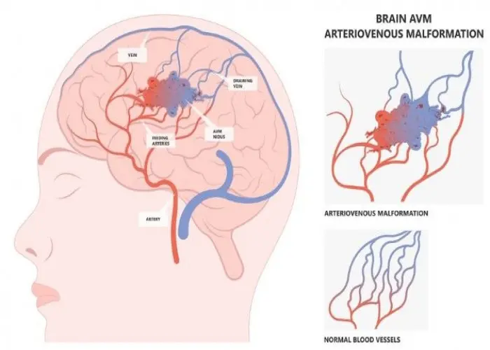 Intracranial venous malformations