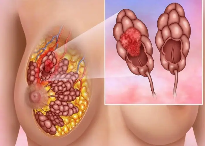 Invasive lobular carcinoma