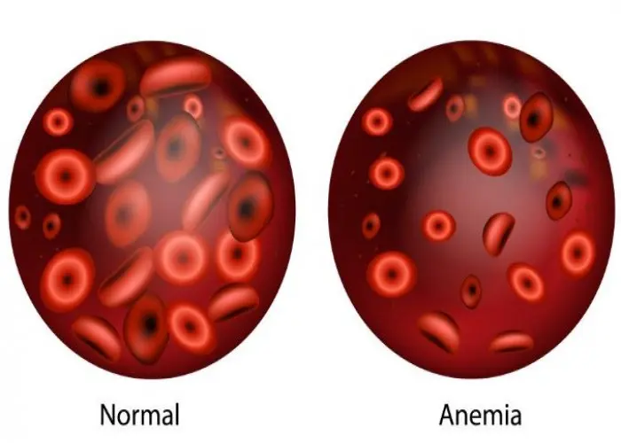 Iron deficiency anemia